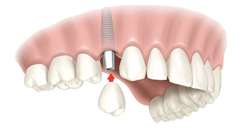 Single Dental Implants New York