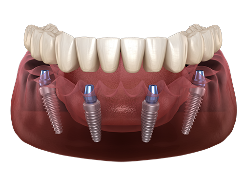 Full Arch Teeth Solutions