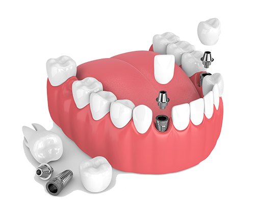 Multiple Teeth Dental Implants in New York